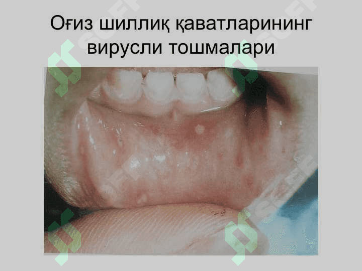 Терининг вирусли касалликлари 7