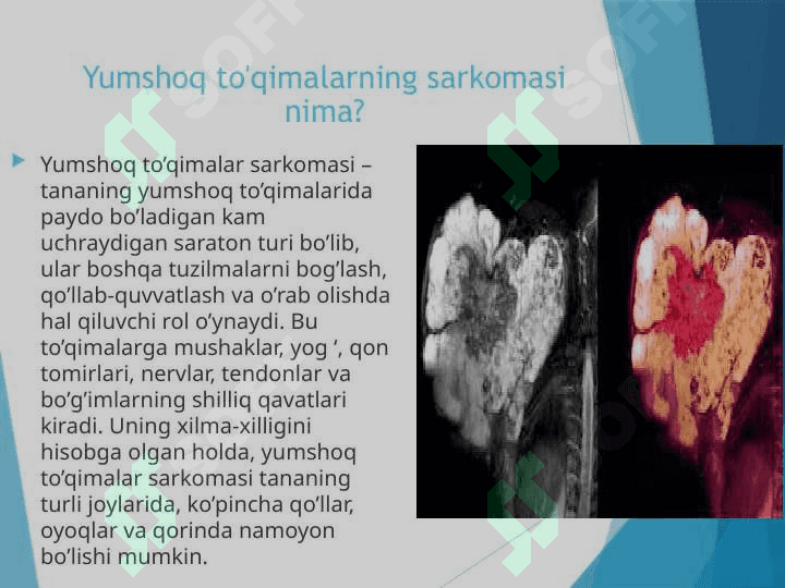 Yumshoq toʻqima sarkomasi 3