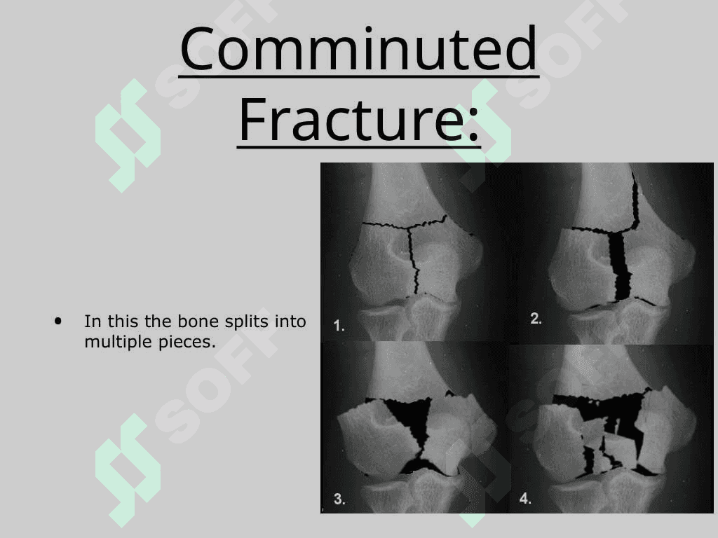 Fractures 8