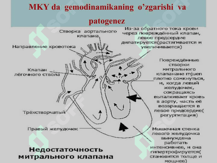 Orttirilgan  Yurak  porogidagi  gemodinamik  o’zgarishlar 5