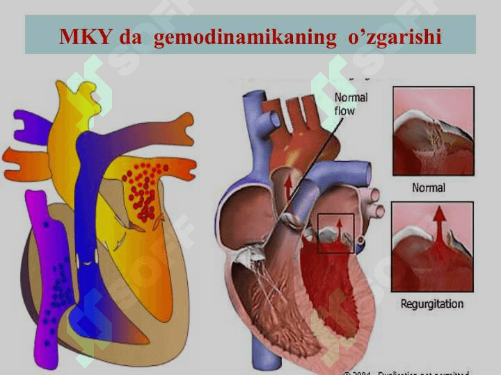 Orttirilgan  Yurak  porogidagi  gemodinamik  o’zgarishlar 6