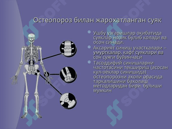 Остеопороз 7