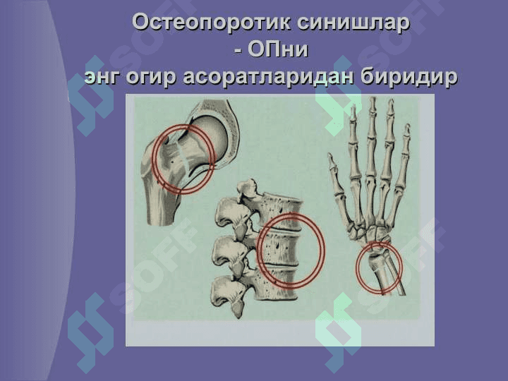 Остеопороз 8