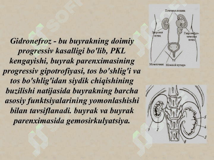 Buyrak tug`ma anomaliyalari.Gidronefroz patogenezi klinikasi etiologiyasi bolalar gidronefrozi 2