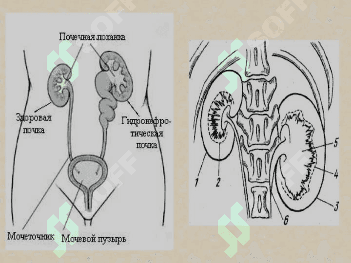 Buyrak tug`ma anomaliyalari.Gidronefroz patogenezi klinikasi etiologiyasi bolalar gidronefrozi 3