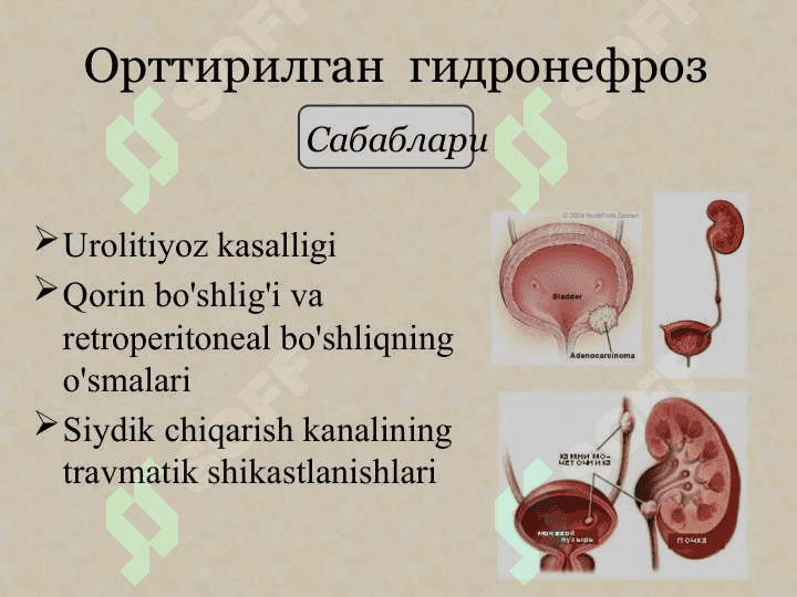 Buyrak tug`ma anomaliyalari.Gidronefroz patogenezi klinikasi etiologiyasi bolalar gidronefrozi 7