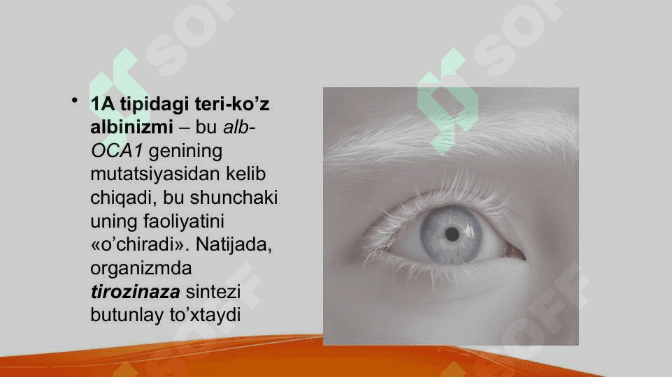 Albinizm.Etiopatogenezi, klinikasi, diagnostikasi, davolash va profilaktikasi 4
