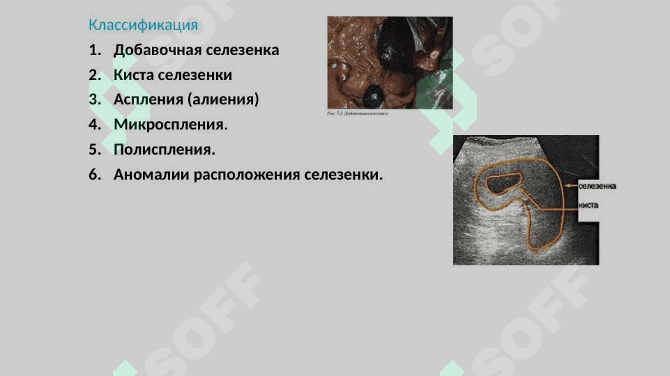 Аномалии развития селезенки 4