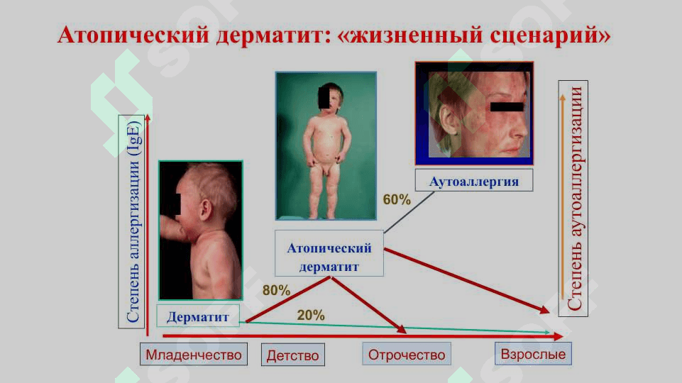 Атопик дерматит 6
