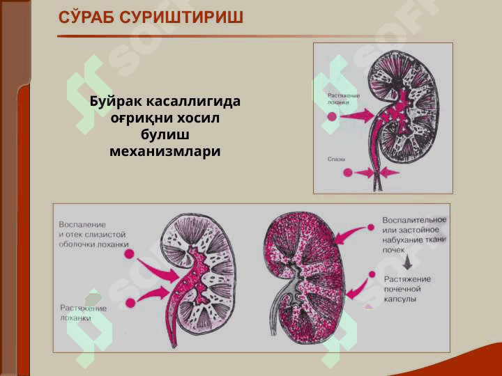 БУЙРАК КАСАЛЛИГИ БИЛАН ОҒРИГАН БЕМОРЛАРНИ ТЕКШИРИШ. АСОСИЙ КЛИНИК СИНДРОМЛАР. БУЙРАК ЕТИШМОВЧИЛИГИ 5