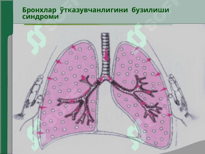 Нафас  органлари  касалликларида  асосийклиник  синдромлар.  Бронхлар  ўтказувчанлигинибузилиши, ўпка  тўқимасида  ҳавони  ортиб  кетиши  синдроми 4