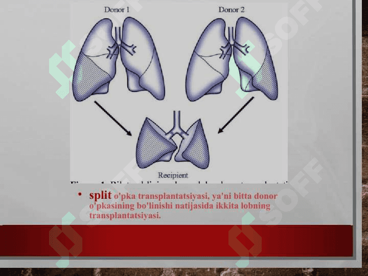 O’pka transplantatsiyasi 4