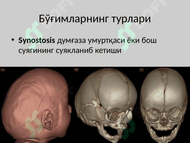 Syndesmologya – суякларнинг ўзаро бирлашуви. 6