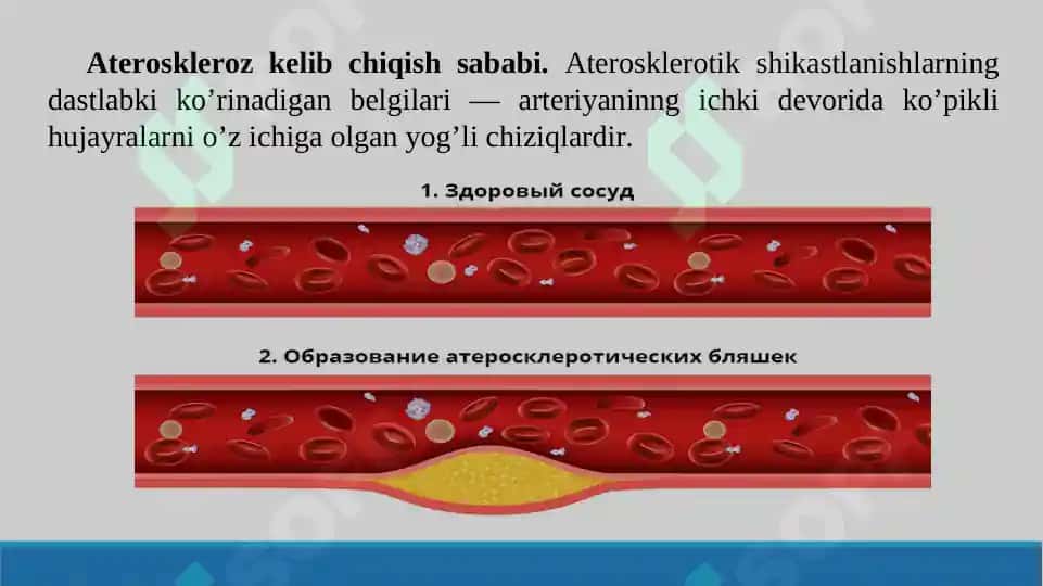 Aterosklerozning kelib chiqish mexanizmi. Taqdimot 16 bet. 5