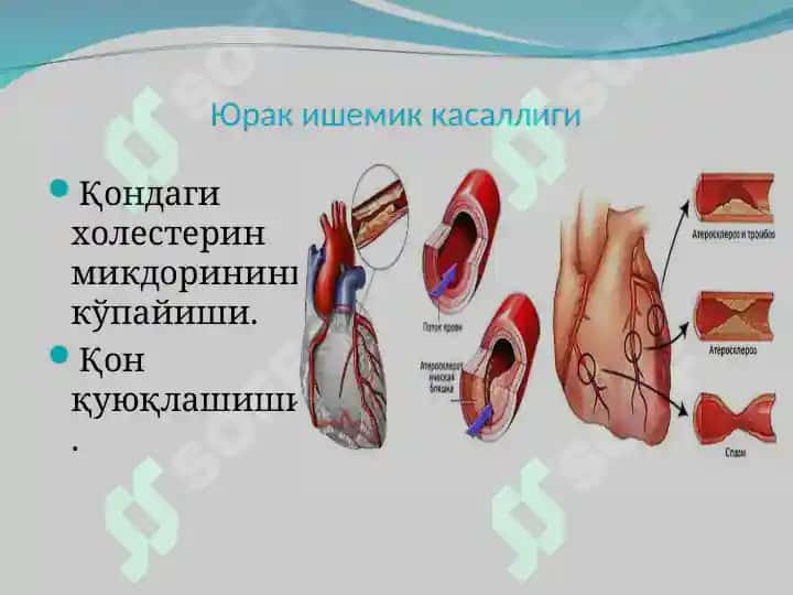 Юрак ишемик касалликлари 4