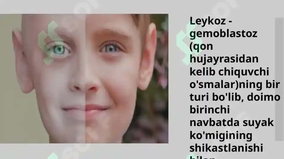 Oʻtkir va surunkali leykoz diagnostikasi 3