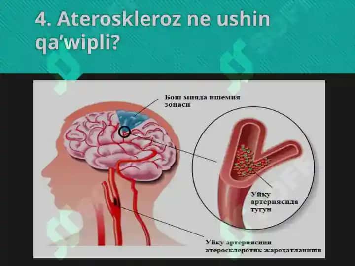 Ateroskleroz rivojlanishi 5