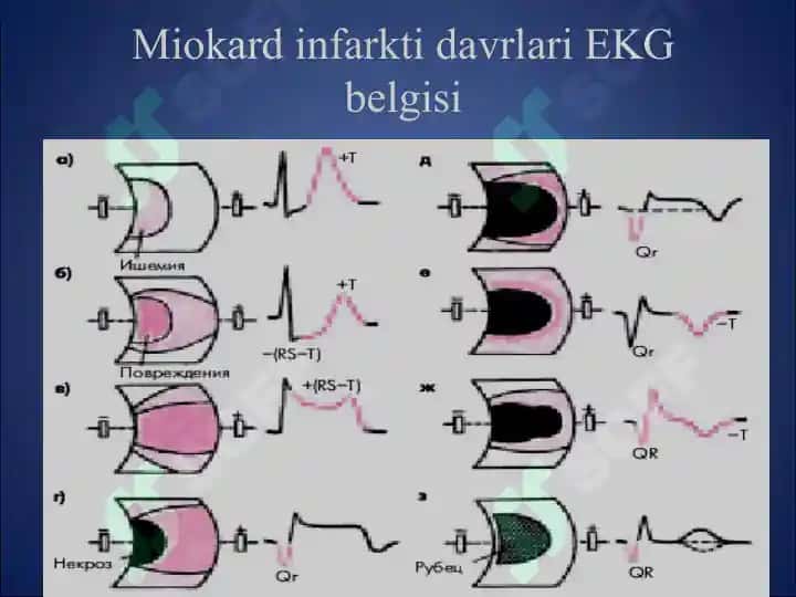 MIOKARD INFARKTI 7