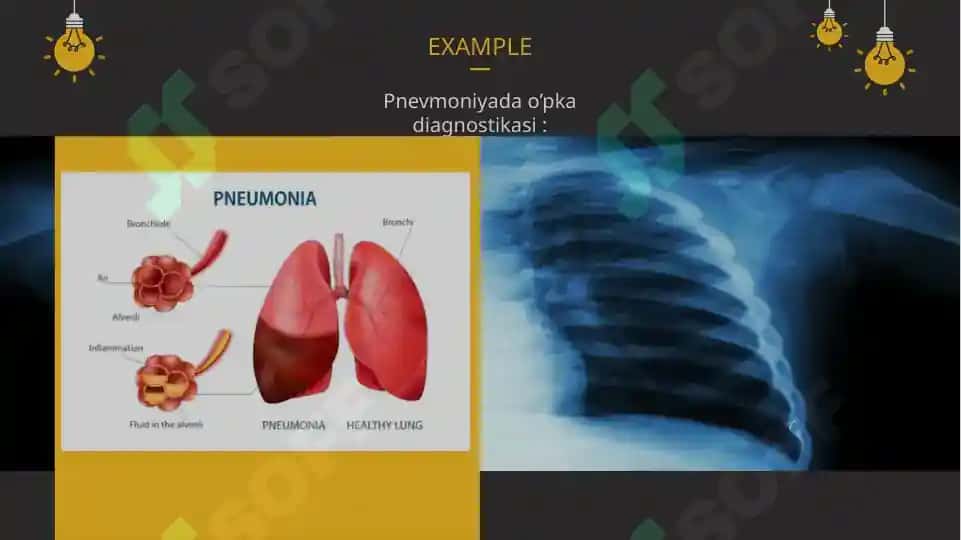 Pnevmoniya (zotiljam) kasalligi 6