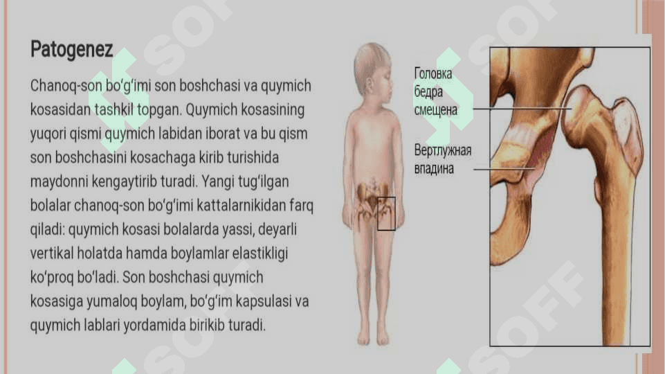 Chanoq-son bo’g’imi displaziyasi. Etiopatogenezi. Klinikasi. Tashxisot. Davolash 3