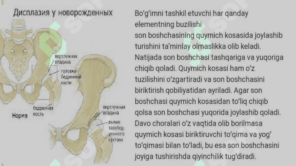 Chanoq-son bo’g’imi displaziyasi. Etiopatogenezi. Klinikasi. Tashxisot. Davolash 5