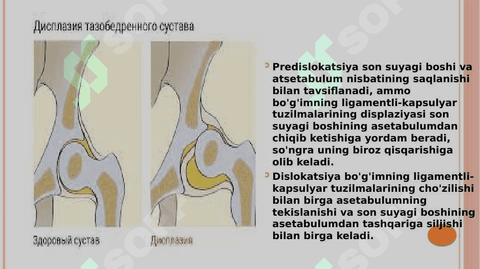 Chanoq-son bo’g’imi displaziyasi. Etiopatogenezi. Klinikasi. Tashxisot. Davolash 6