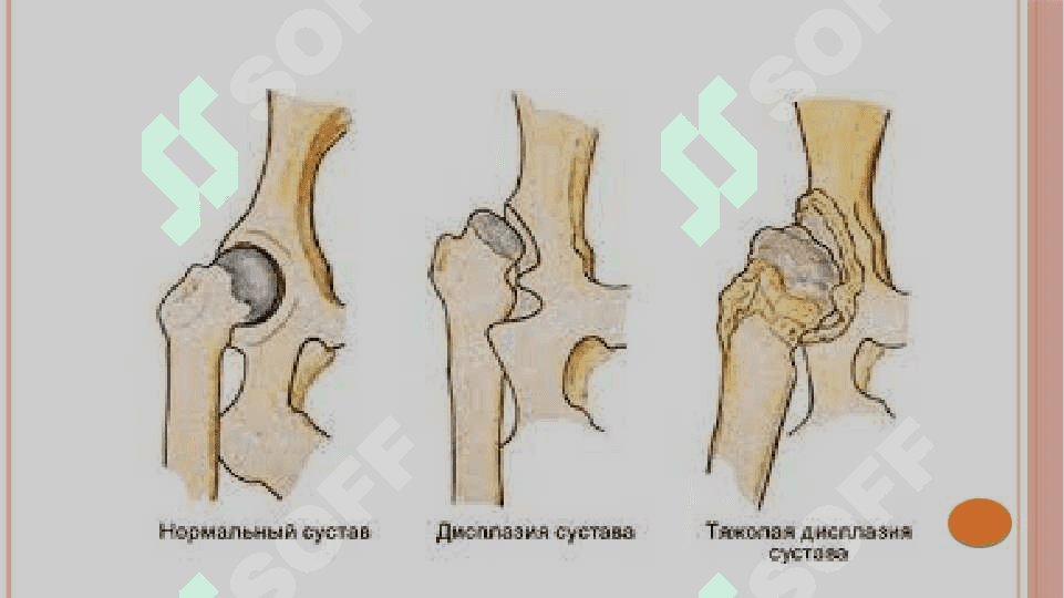 Chanoq-son bo’g’imi displaziyasi. Etiopatogenezi. Klinikasi. Tashxisot. Davolash 7
