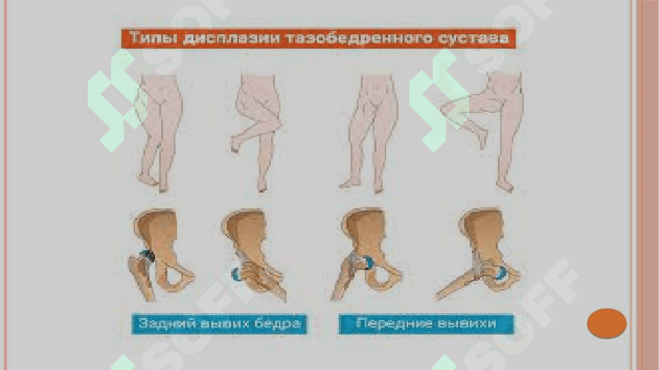 Chanoq-son bo’g’imi displaziyasi. Etiopatogenezi. Klinikasi. Tashxisot. Davolash 8