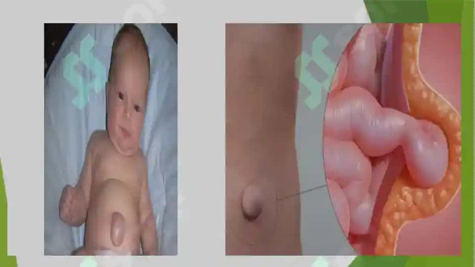 Bolalarda kindik tizimchasi churrasi 3
