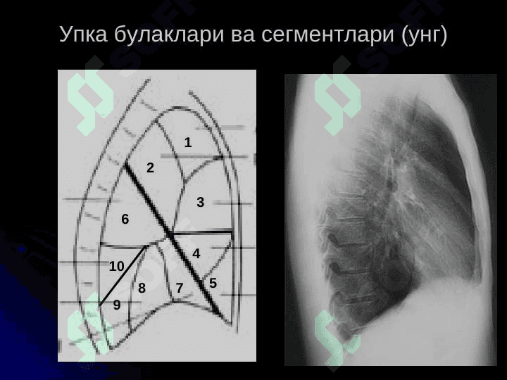 Упка касалликларининг нур ташхиси 5