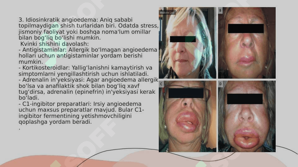 Dermatologik sindromni taqqoslash teri qichishi, shish, toshmalar. Eshak emi. Kvinke shishi 4