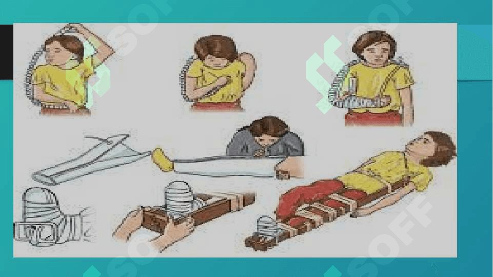 SHIKASTLANGAN O’CHOQLARDA DASTLABKI TIBBIY YORDAMNI TASHKIL QILISH 2