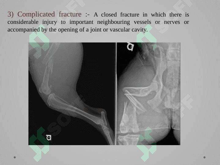 FRACTURE CLASSIFICATION 4