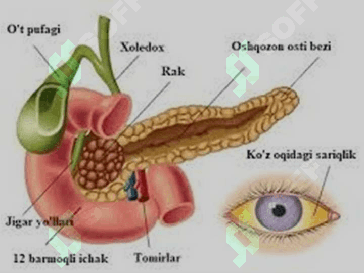 HAVFLI ETIALOGIYALI MEXANIK SARIQLIK 4