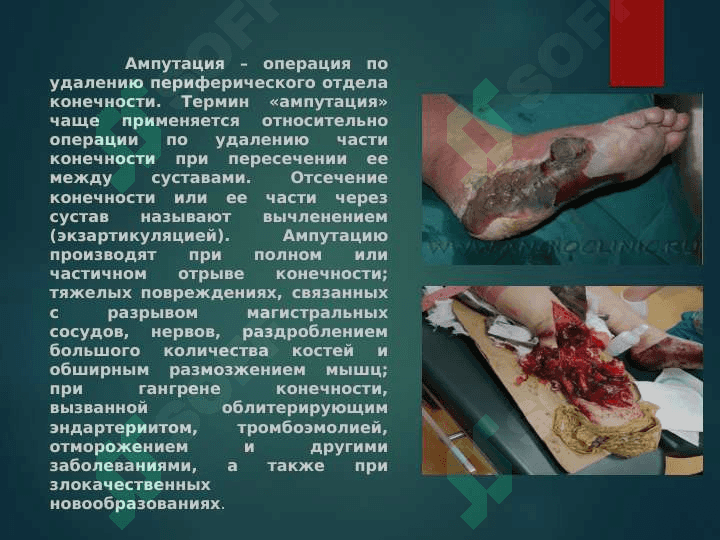 ампутация протезирование и реабилитация инвалидов 2
