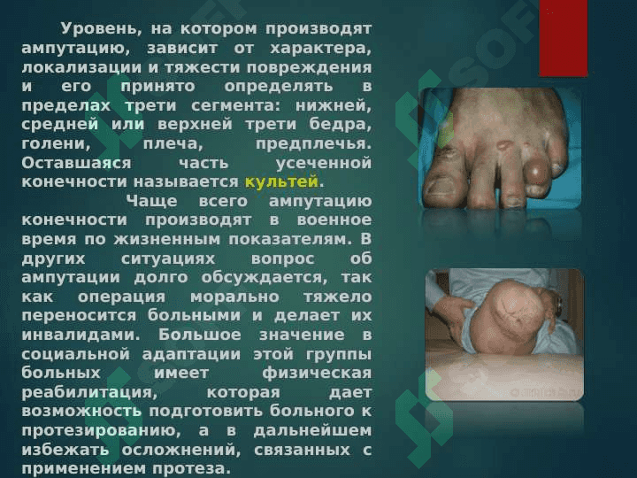 ампутация протезирование и реабилитация инвалидов 3
