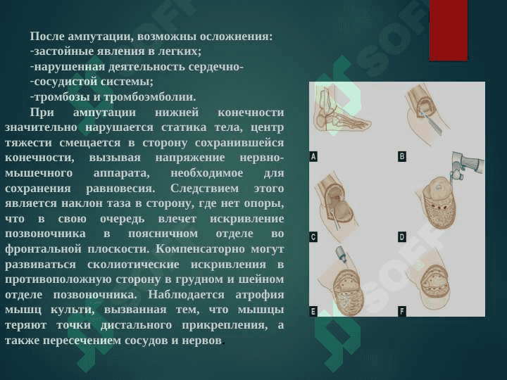 ампутация протезирование и реабилитация инвалидов 4