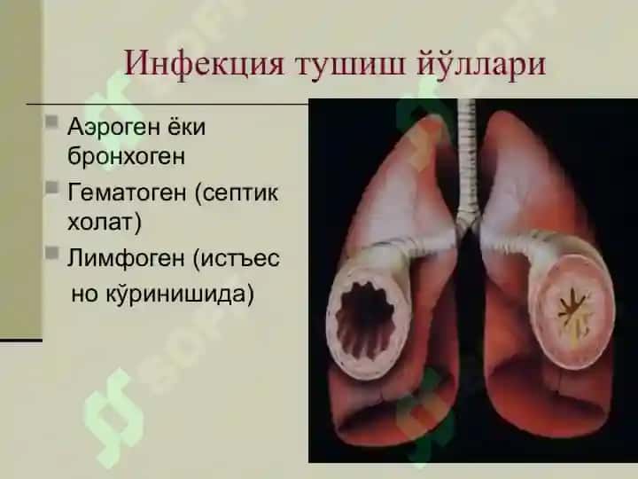 Пневмония (Pneumonia) 7
