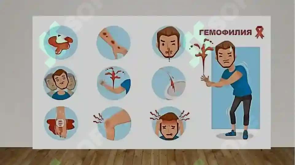 Qonning nasliy (gemofiliya) kasalliklari, multifaktorial kasalliklar 6