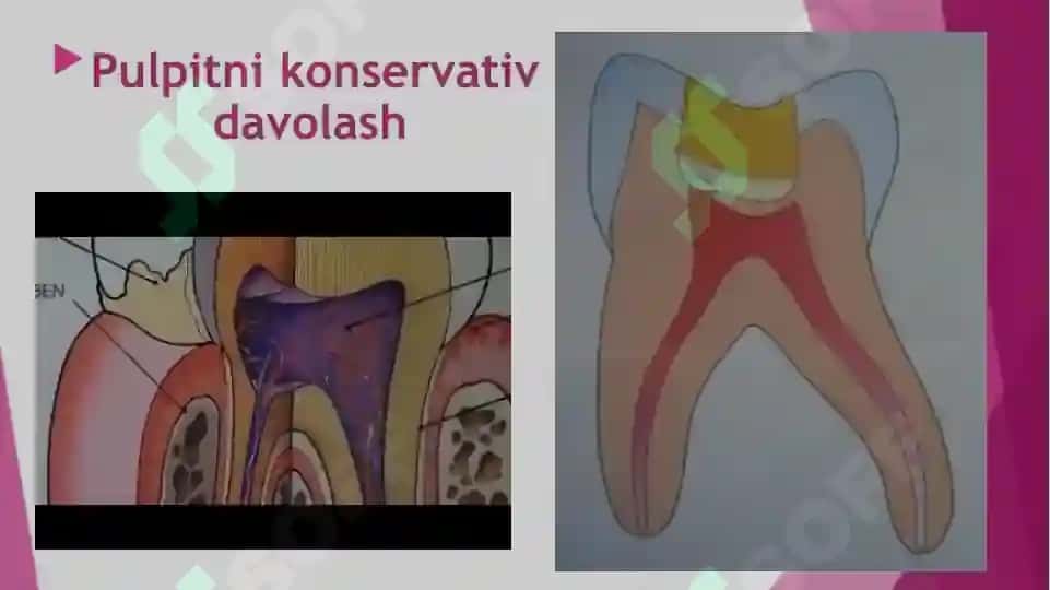 pulpitlarni tashxislash va davolash 5
