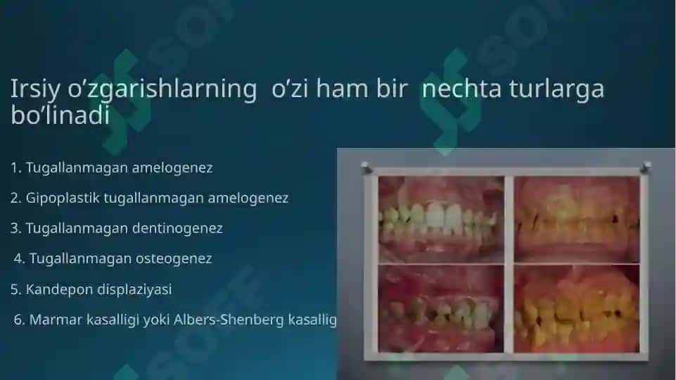 Tish toj qismining qisman yo’qotilishi 4