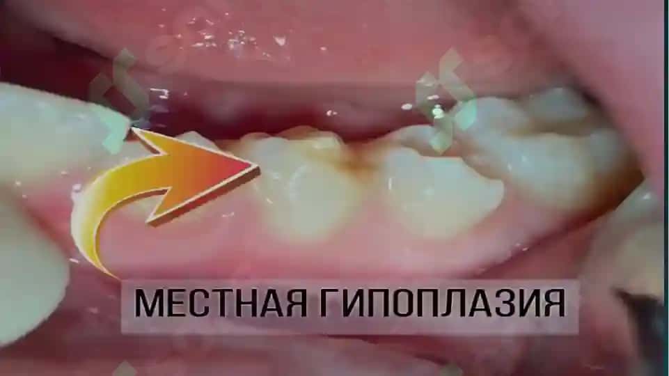 Tish toj qismining qisman yo’qotilishi 8
