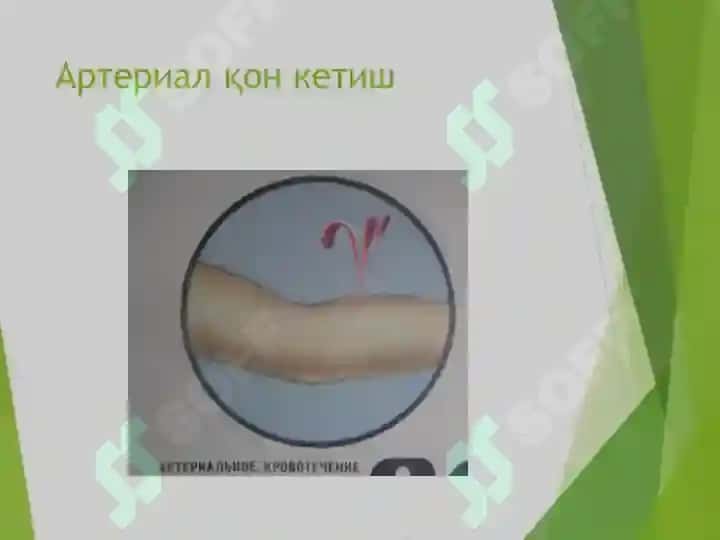 Қон кетиш 4