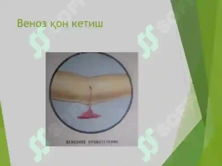Қон кетиш 5