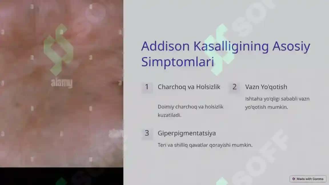 Addison kasalligi 3