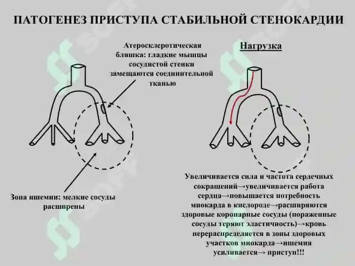 Антиангинальное средство 2