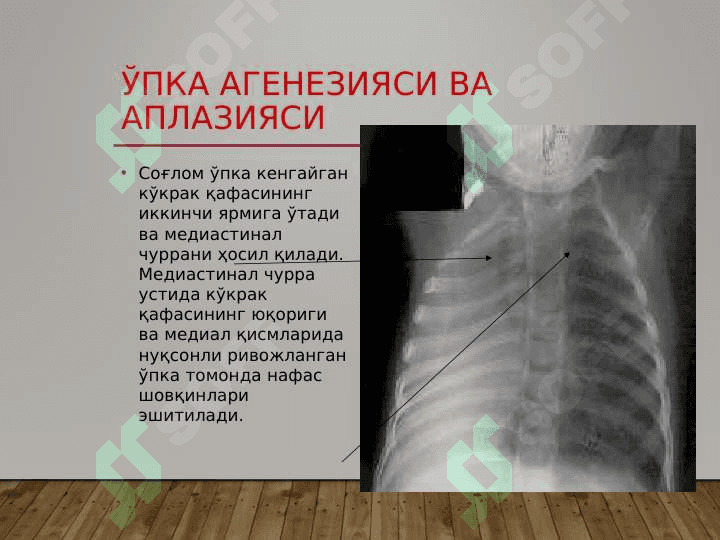 Ўпкаларнинг туғма ривожланиш нуқсонлари ва аномалиялари- O'pkani tug'ma rivojlanish nuqsonlari va anomaniyalari 7