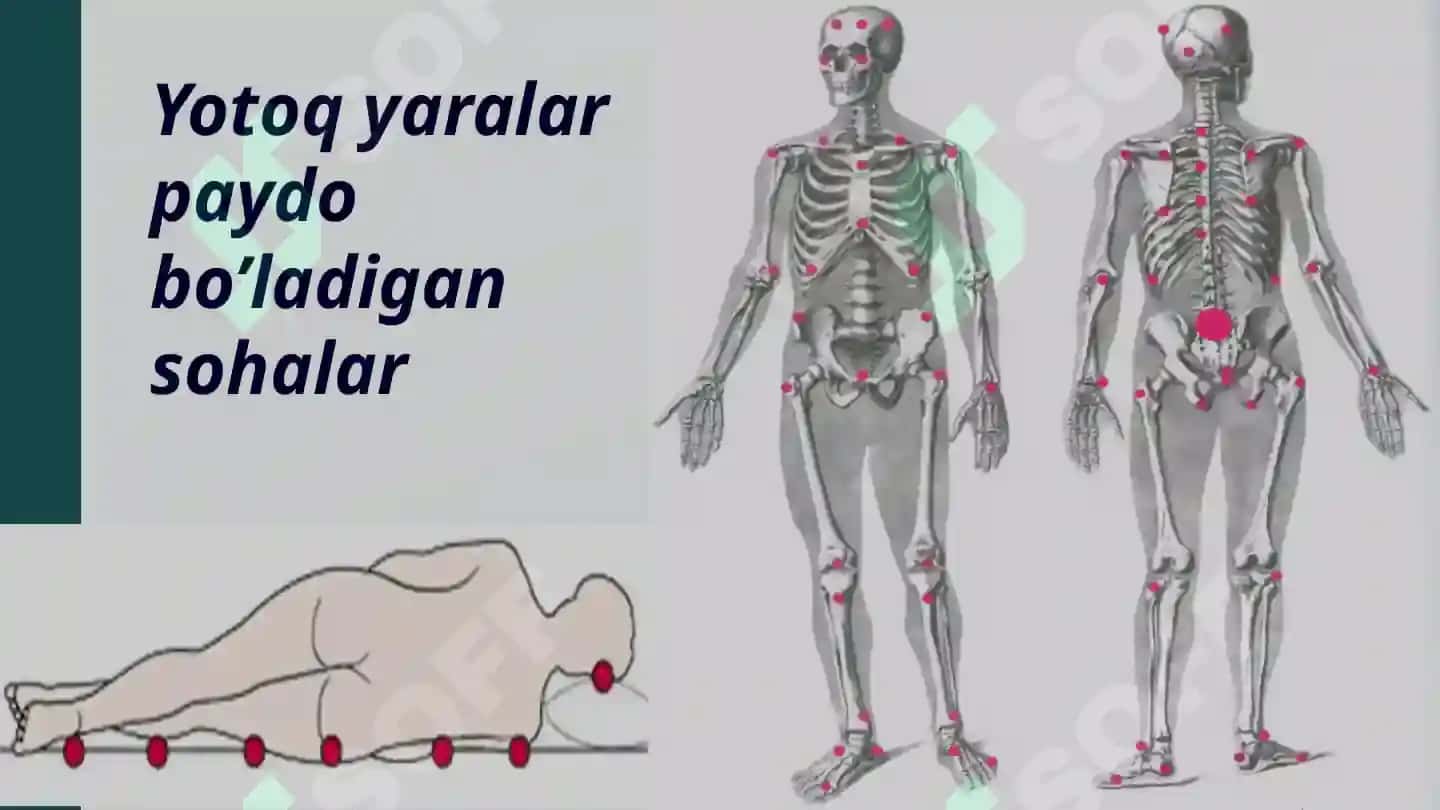 Yotoq yaralar haqida batafsil ma'lumotlar. 5