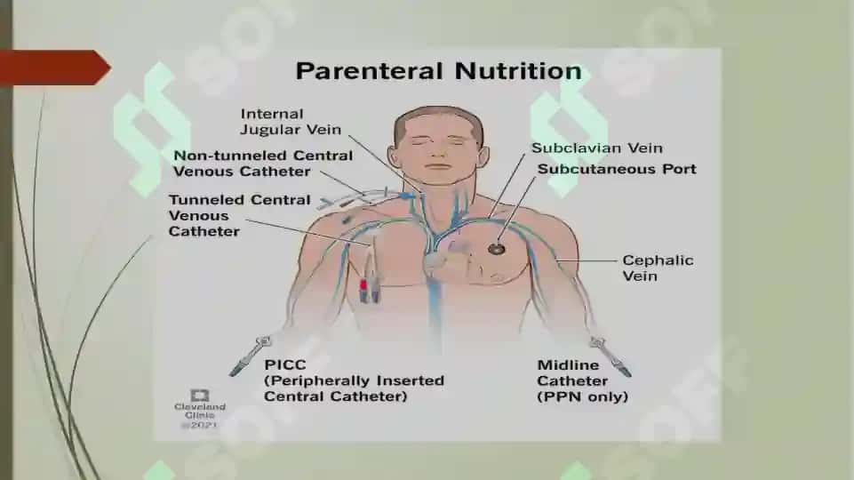 Parenteral oziqlantirish 4
