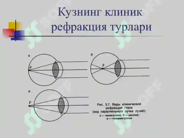 Клиник рефракция. Рефракция аномалияларини диагностикаси 6